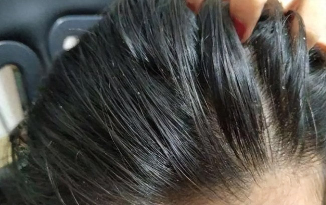 频繁洗头反而加重油脂分泌 医生提醒 为什么头发越洗越油