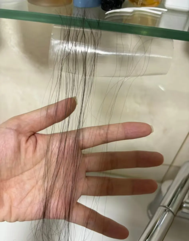 发缝越来越宽怎么办？这种情况要赶紧治疗